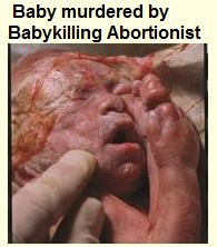 Baby aborted by babykilling abortionist